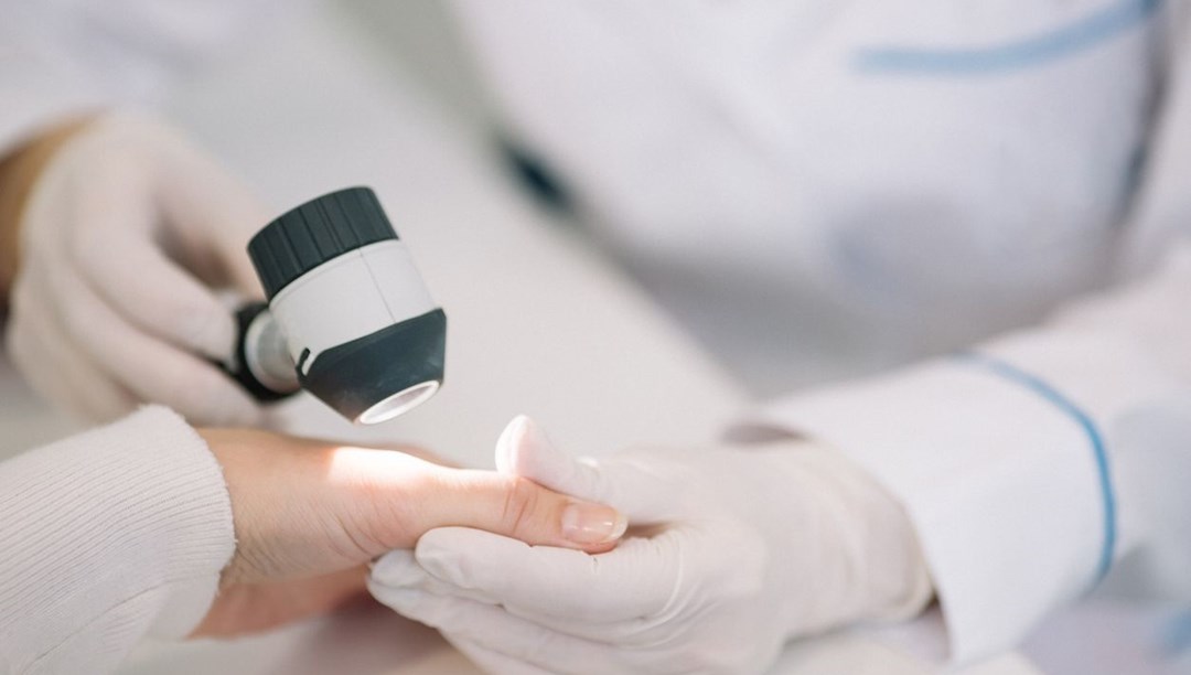 Cilt kanseri olan doktor görmezden geldiği belirtiyi açıkladı: Meğer vücuduna yayılmış