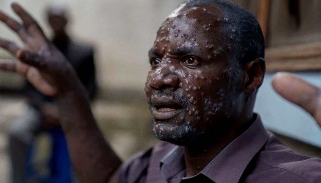M çiçeği salgınında korkutan artış: Sierra Leone’de virüs patladı
