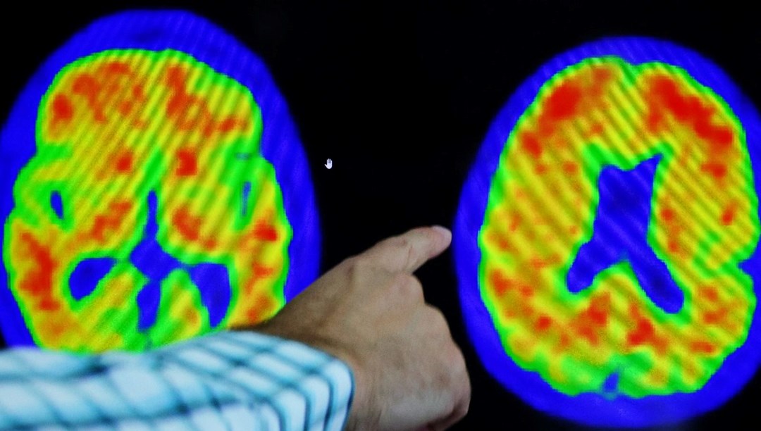 Uçuk ve Alzheimer arasında bağlantı keşfedildi