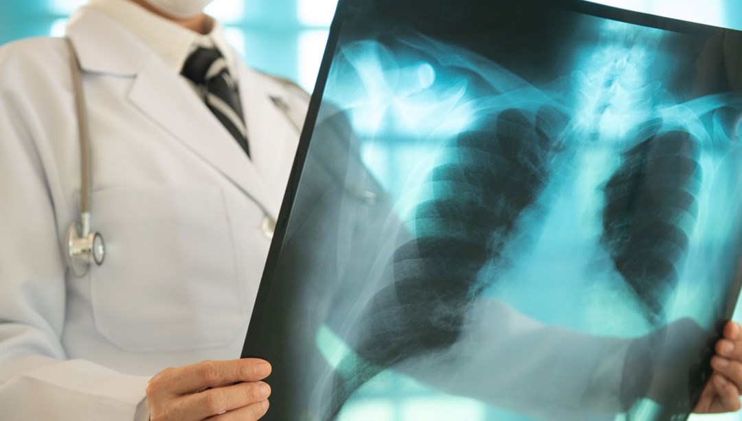 Sigara içmeyenlerde neden Akciğer kanseri görülüyor: 5 nedeni var