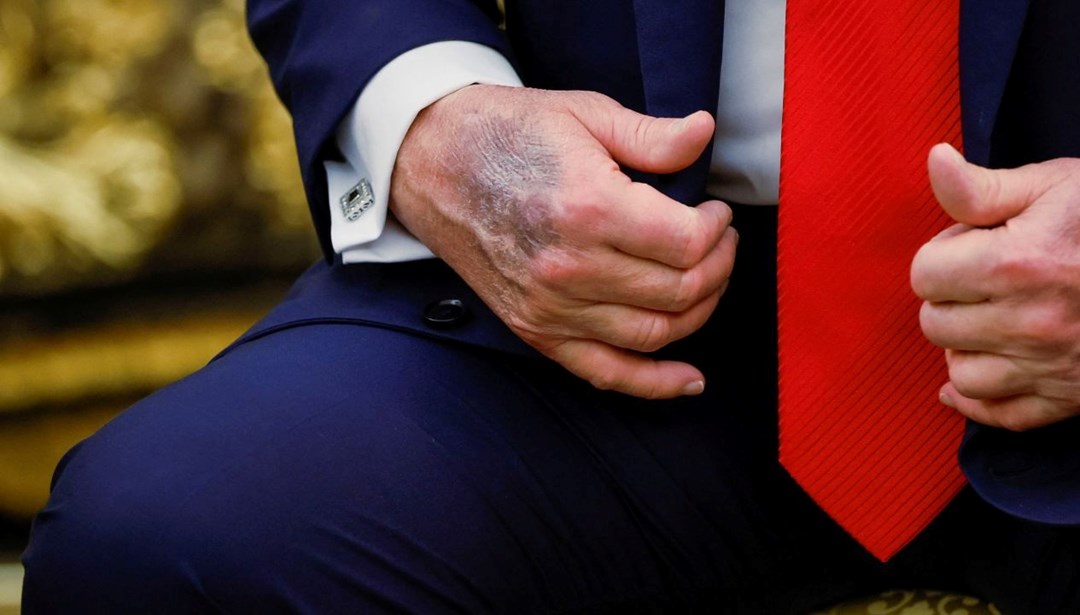 Trump’ın eli yine gündem oldu, Beyaz Saray’dan açıklama geldi