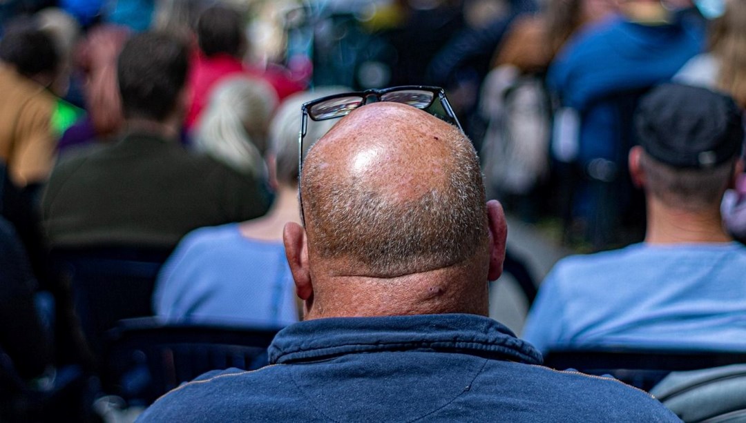 Kellik tedavisinde yeni umut: 20 günde saçları uzattı